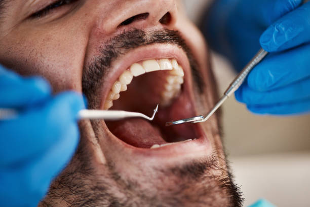 Best Emergency Wisdom Tooth Extraction in Volo, IL